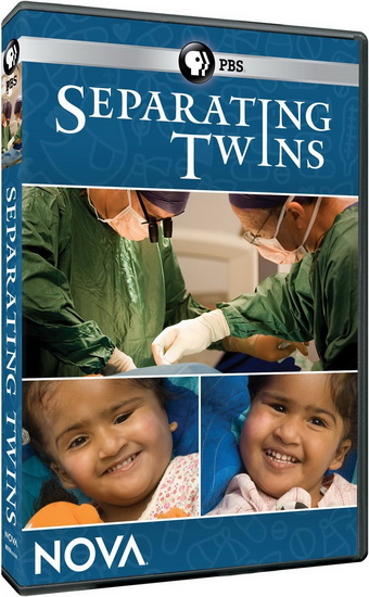 Nova Separating Twins - 