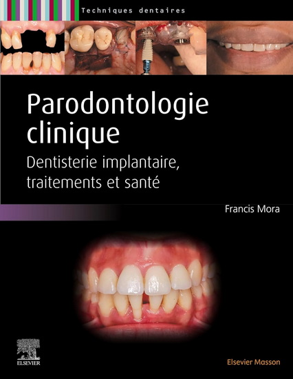 Parodontologie clinique : dentisterie implantaire, traitements et santé - FRANCIS MORA